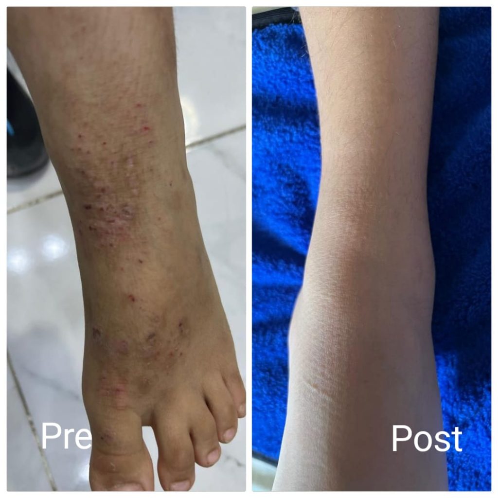 علاج الاكزيما قبل وبعد